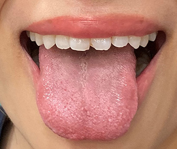 舌がん診察（口腔粘膜外来）　（毎週土曜日）