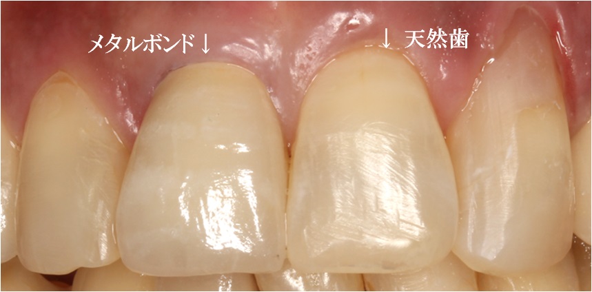 審美歯科症例02