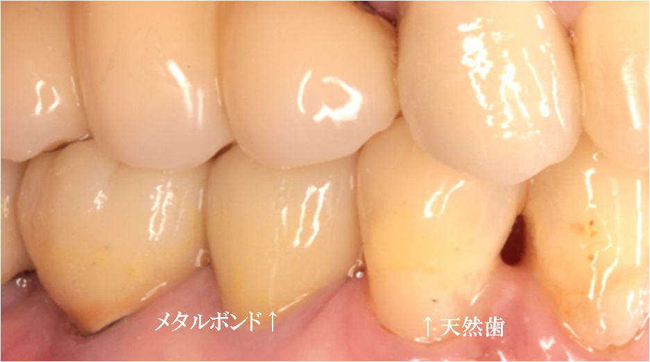 審美歯科症例02