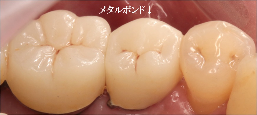 審美歯科症例02