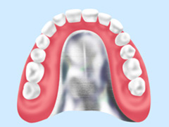 金属床義歯