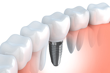 失った歯の機能回復につなげます～インプラント治療～
