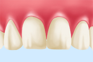歯の内側からの着色