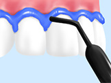歯茎保護